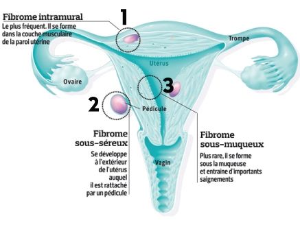 Schéma Fibromes de l'utérus Radiologie Interventionnelle CHU Dijon